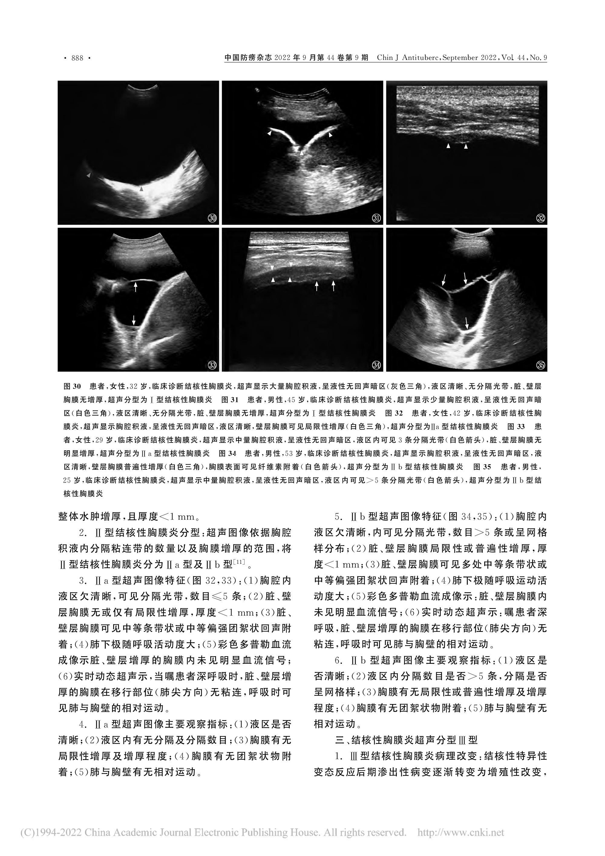 2022結(jié)核性胸膜炎超聲診斷、分型及介入治療專(zhuān)家共識(shí)(2022年版)-9.jpg