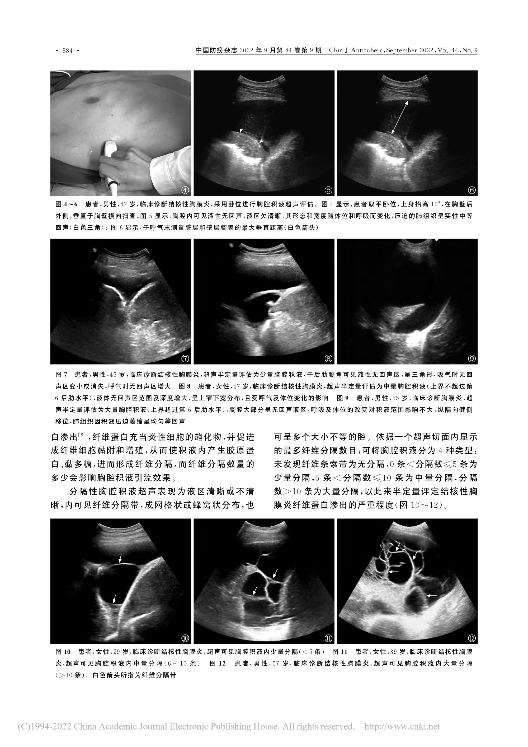 2022結(jié)核性胸膜炎超聲診斷、分型及介入治療專(zhuān)家共識(shí)(2022年版)-5.jpg